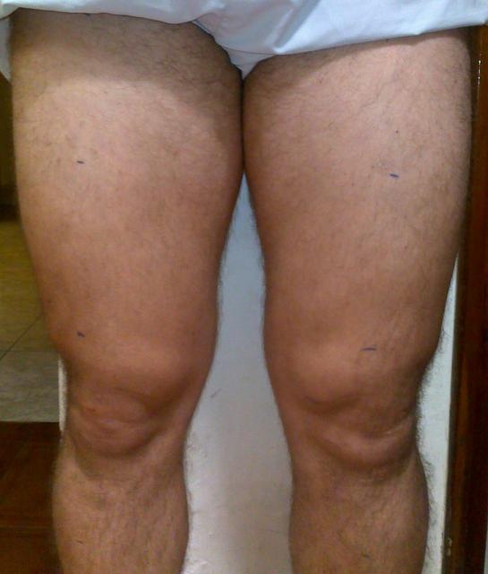 7 meses e 10 dias após a cirurgia